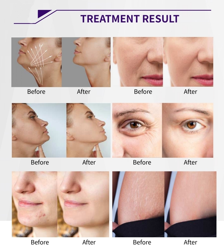 4d hifu application