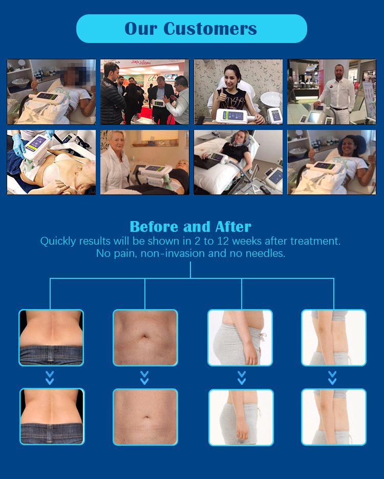 https://www.sincoherenbeaut.com/cryolipolysis-coolsculpting-machine/