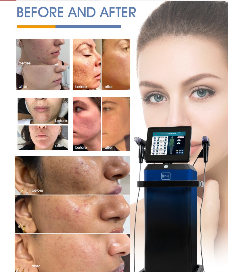 Crystallite Depth 8 machine before and after