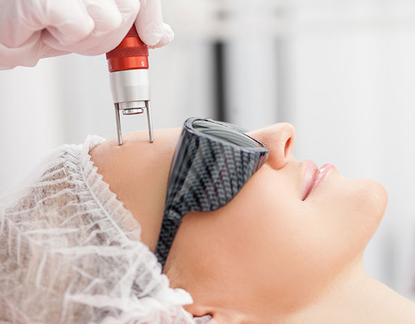 fractional-laser-resurfacing