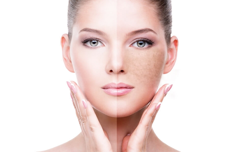 Pigmentation-Treatment