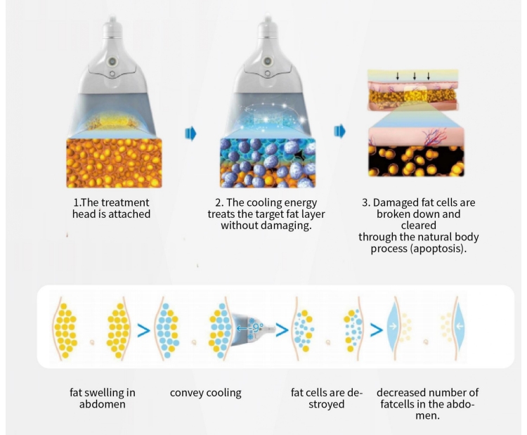 360° coolsculpting cryolipolysis slimming machine principle
