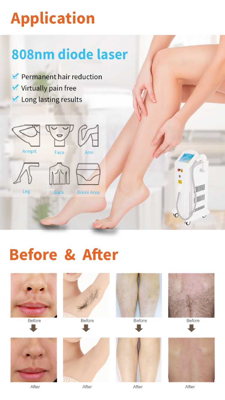razorlase diode laser hair removal machine effect