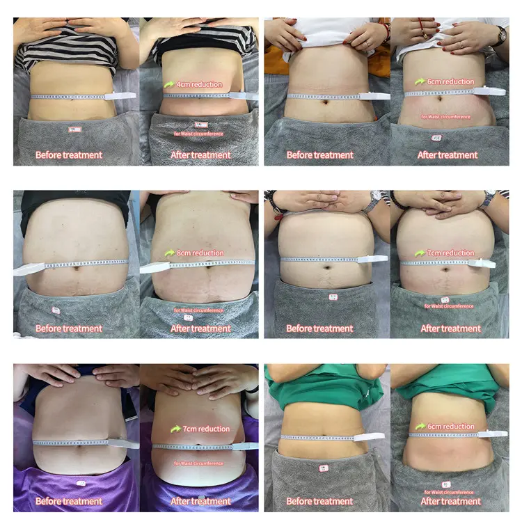 1060nm Laser Lipolysis Body Slimming Machine (8)