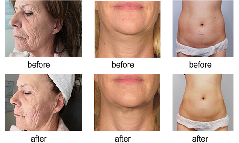 3D HIFU machine before and after