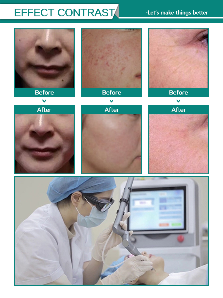 How many times can you do fractional CO2 laser?