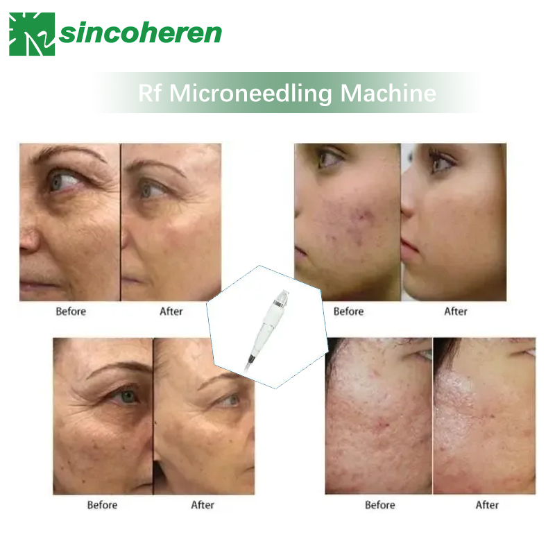 Microneedle Fractional Facial Skin Rejuvenation Machine