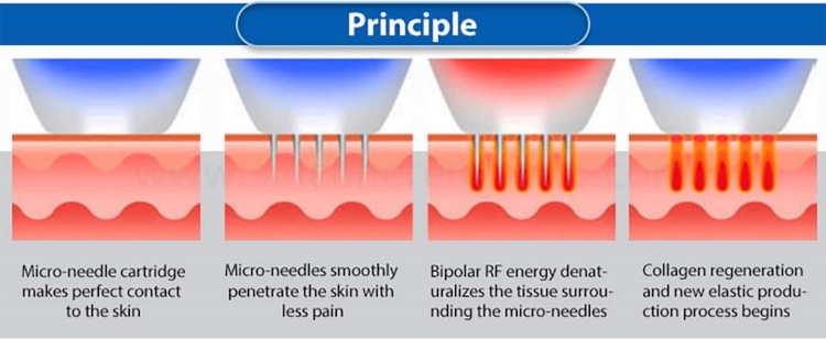 fractional-rf-microneedling-how-it-works