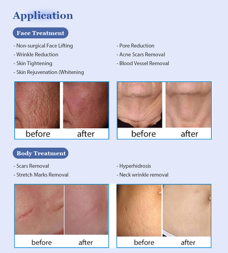 RF-301 Fractional Microneedling RF Machine-4