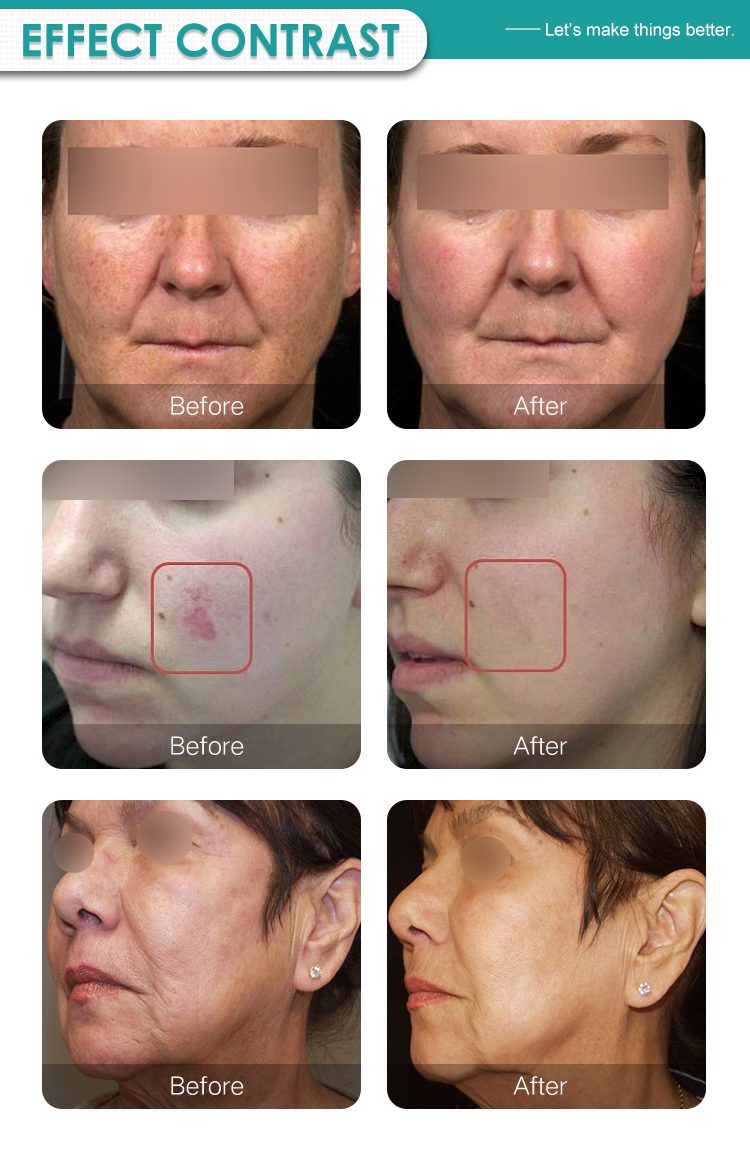 fractional co2 laser  skin rejuvenation