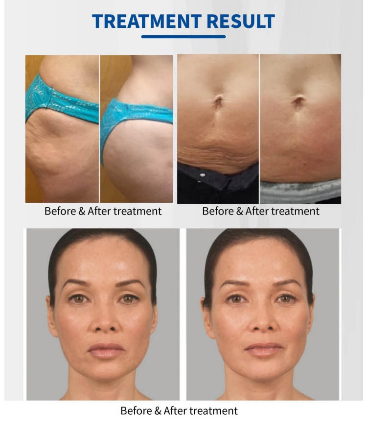 cavitation rf slimming10