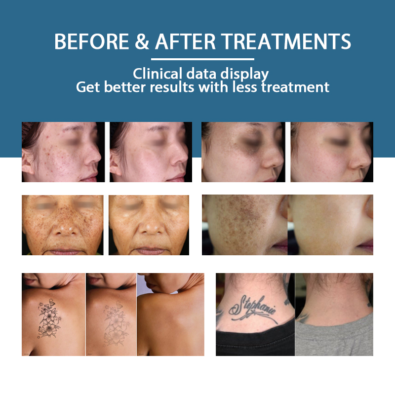 Pico Laser Tattoo Removal Maachine