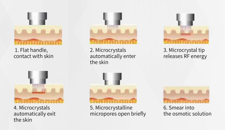RF Microneedling Portable Fractional Face Lifting Skin Tightening Machine