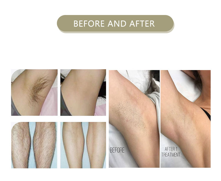 didoe laser hair removal