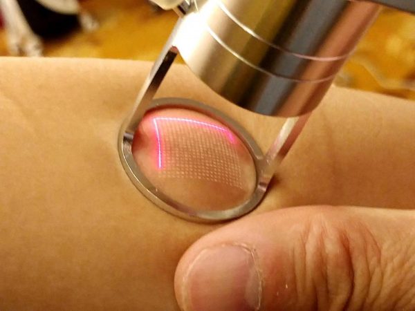 Co2-Fractional-Laser-treatment-scanning-mode