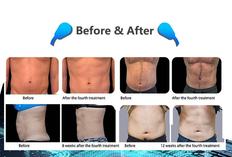 emsculpt application
