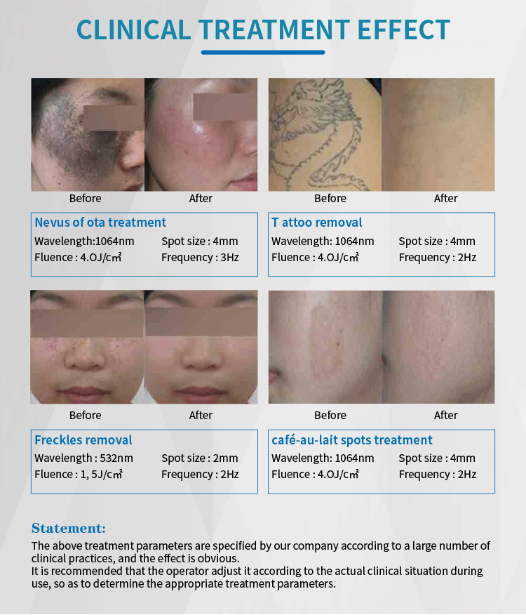 Q Switched Nd Yag Laser Machine