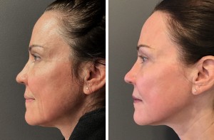 co2 laser treatments