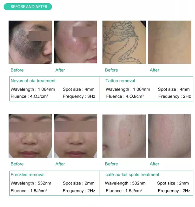 Q Switched Nd Yag Laser For Hyperpigmentation