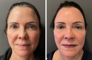 co2 laser treatments