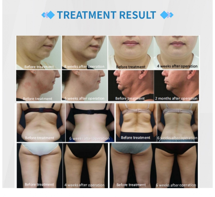 360° coolsculpting cryolipolysis slimming machine effect