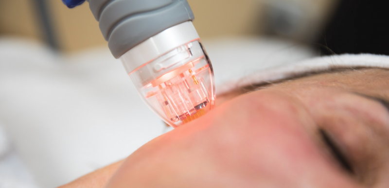 RF-Microneedling