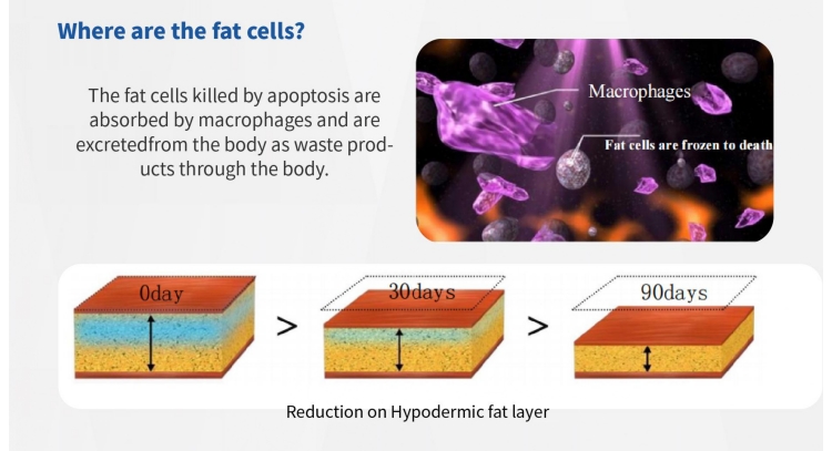 360° coolsculpting cryolipolysis slimming machine principle