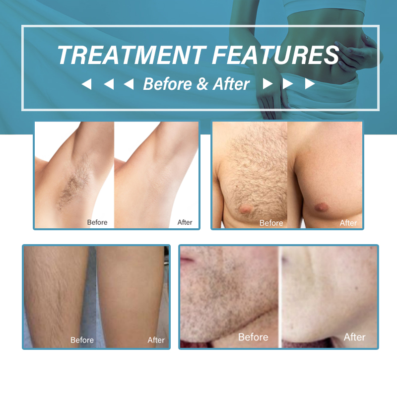 diode laser hair removal machine