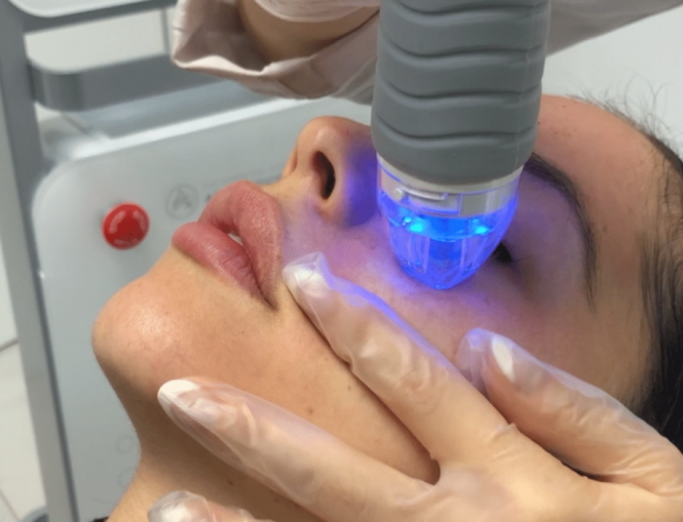 microneedle rf skin resurfacing