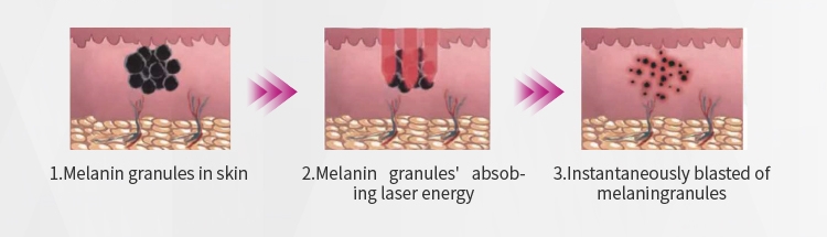 Multi Pulse Q-Switched Nd:YAG Laser Machine